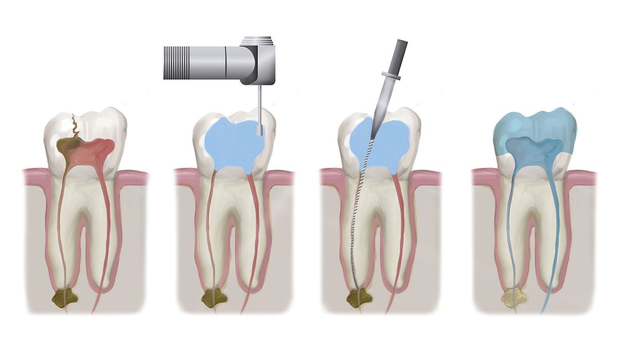 Root Canal Procedure