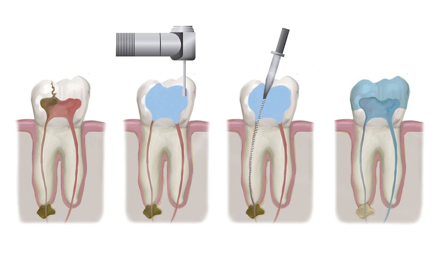 Series of illustrations demonstrating the stages of a root canal procedure.