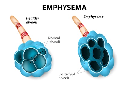 Illustration highlighting the results of emphysema