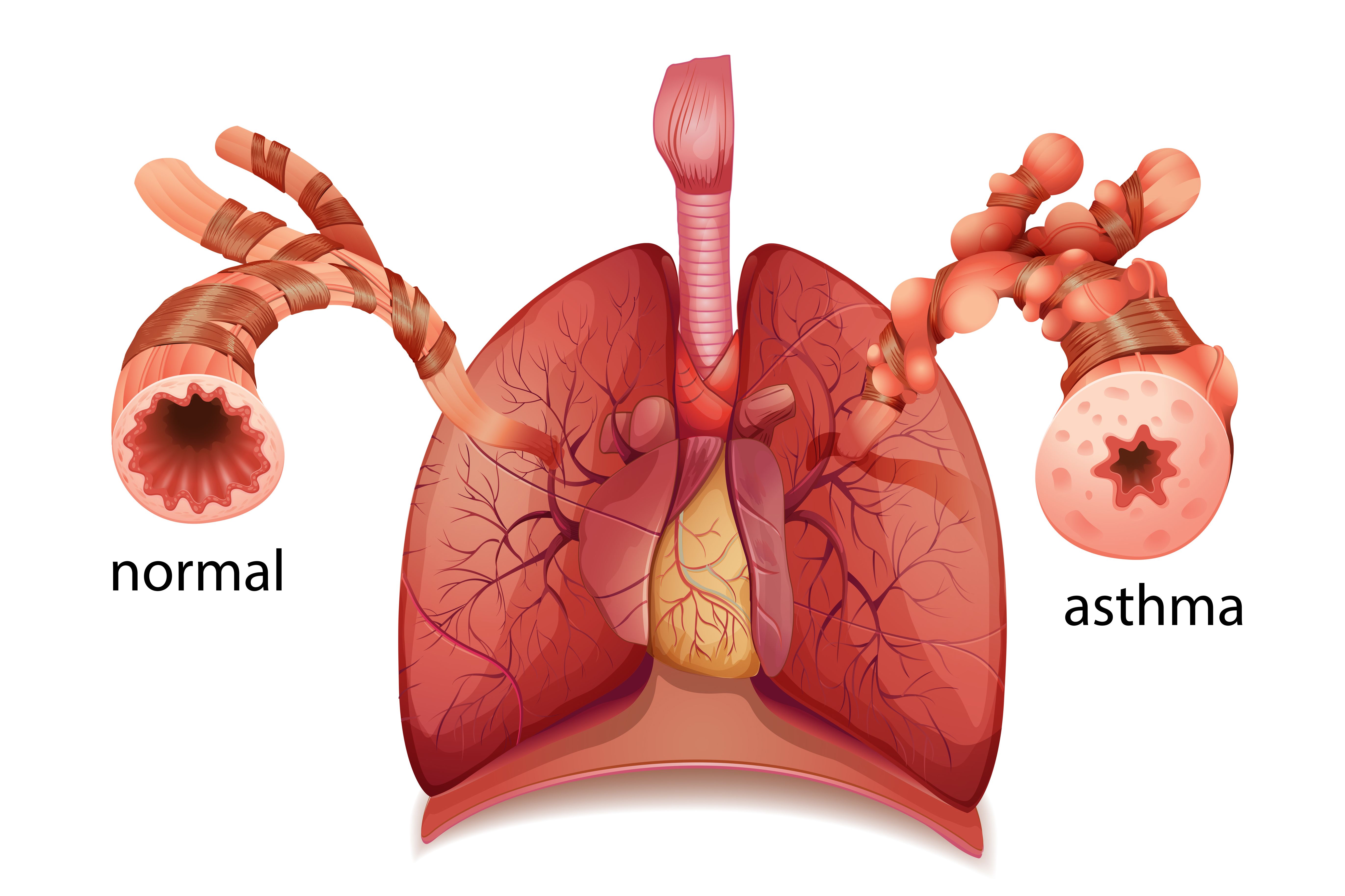 Digital illustration comparing a normal airway to an airway with asthma