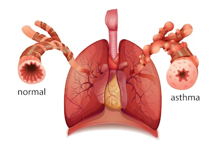 Digital illustration comparing a normal airway to an airway with asthma