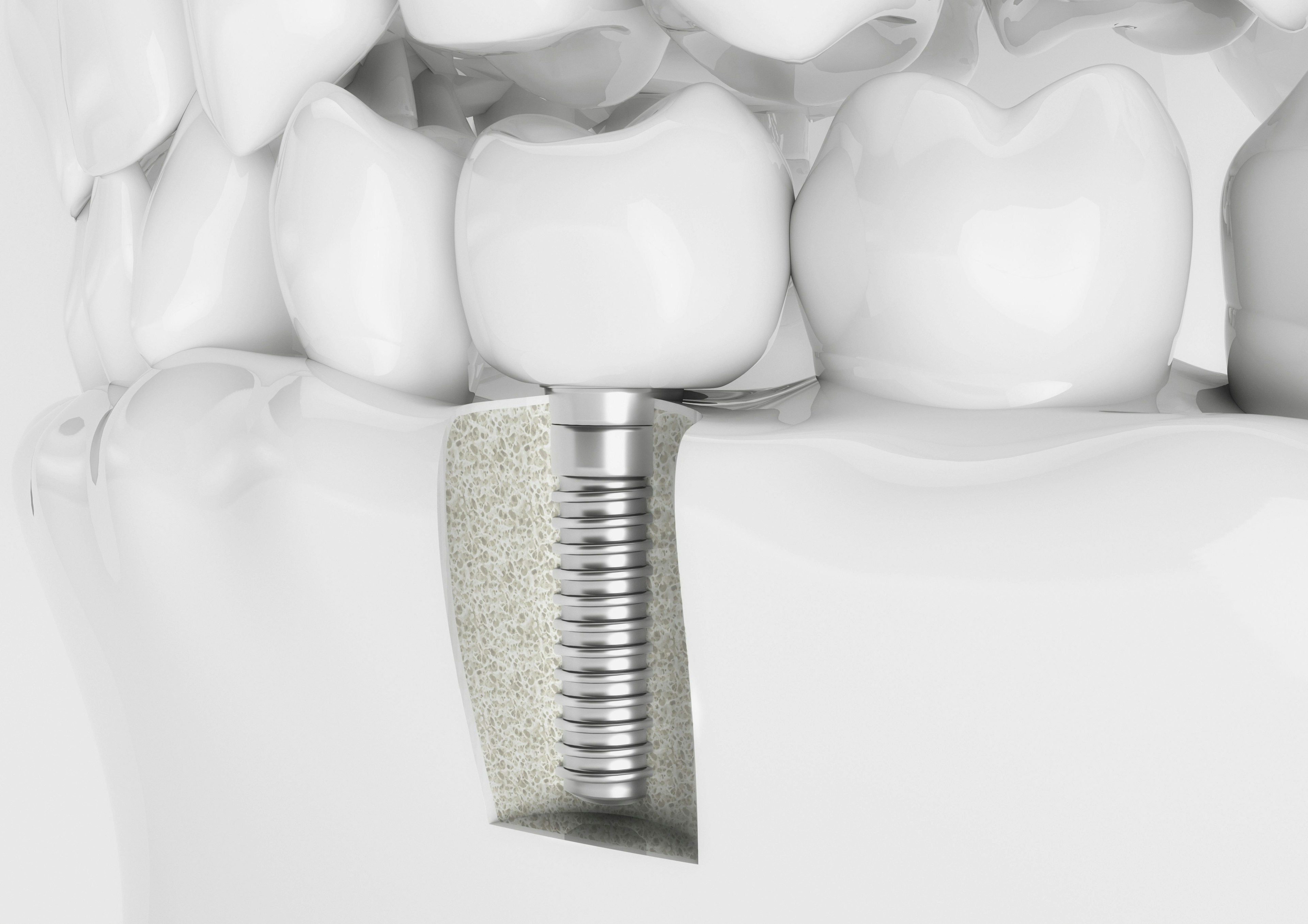 Dental implant
