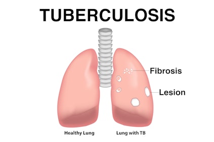 Illustration showing the results of tuberculosis