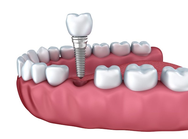 illustration showing full implant above jaw with missing tooth