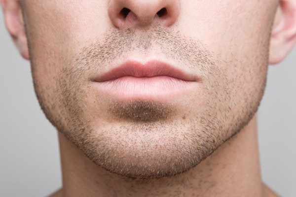 Man with augmented chin