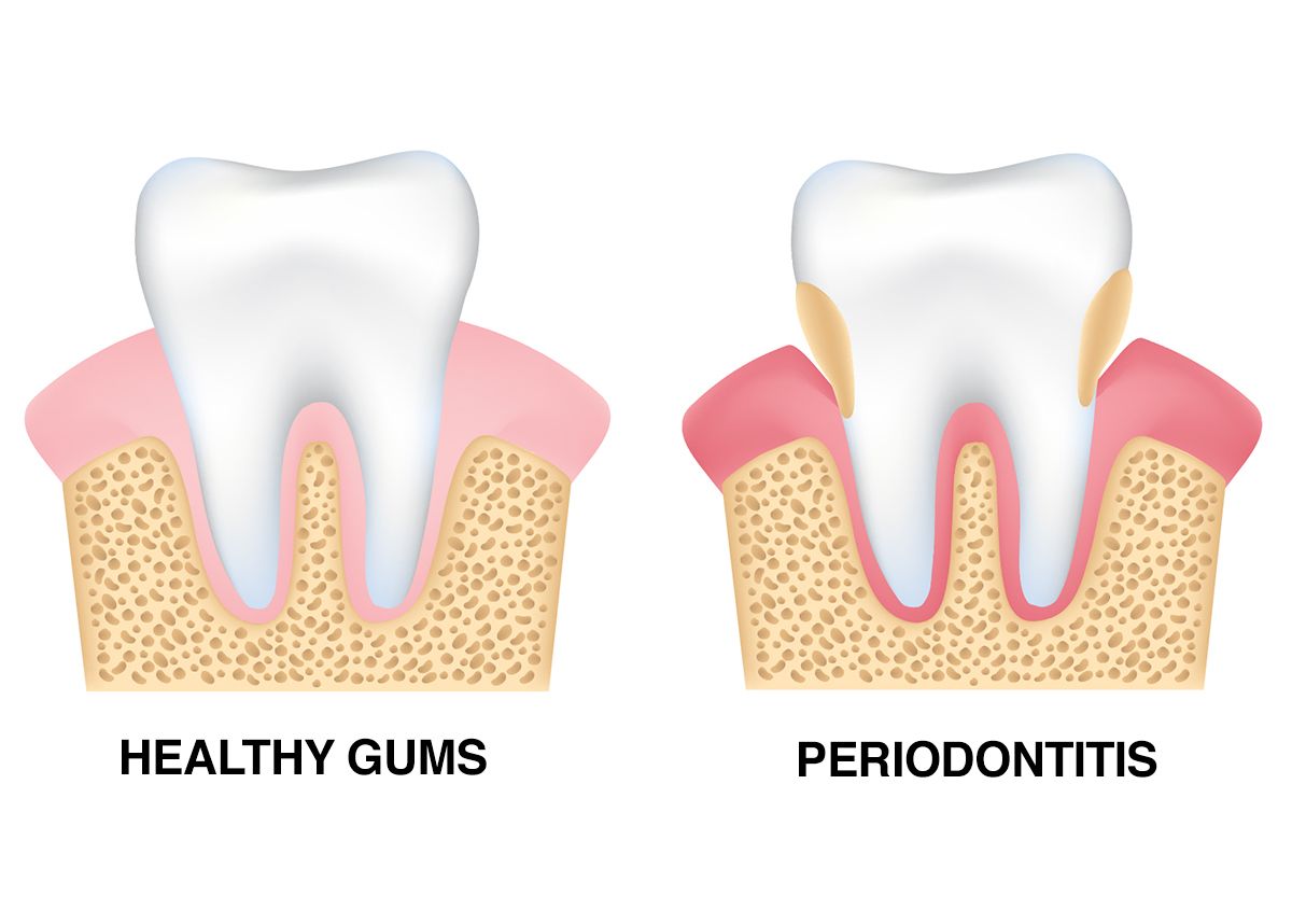 An illustration showing the results of periodontitis