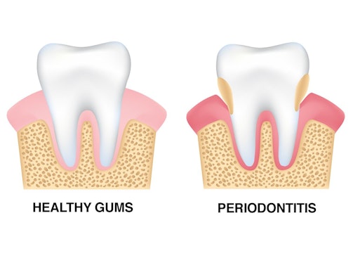 An illustration showing the results of periodontitis
