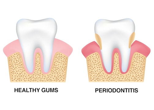An illustration showing the results of periodontitis