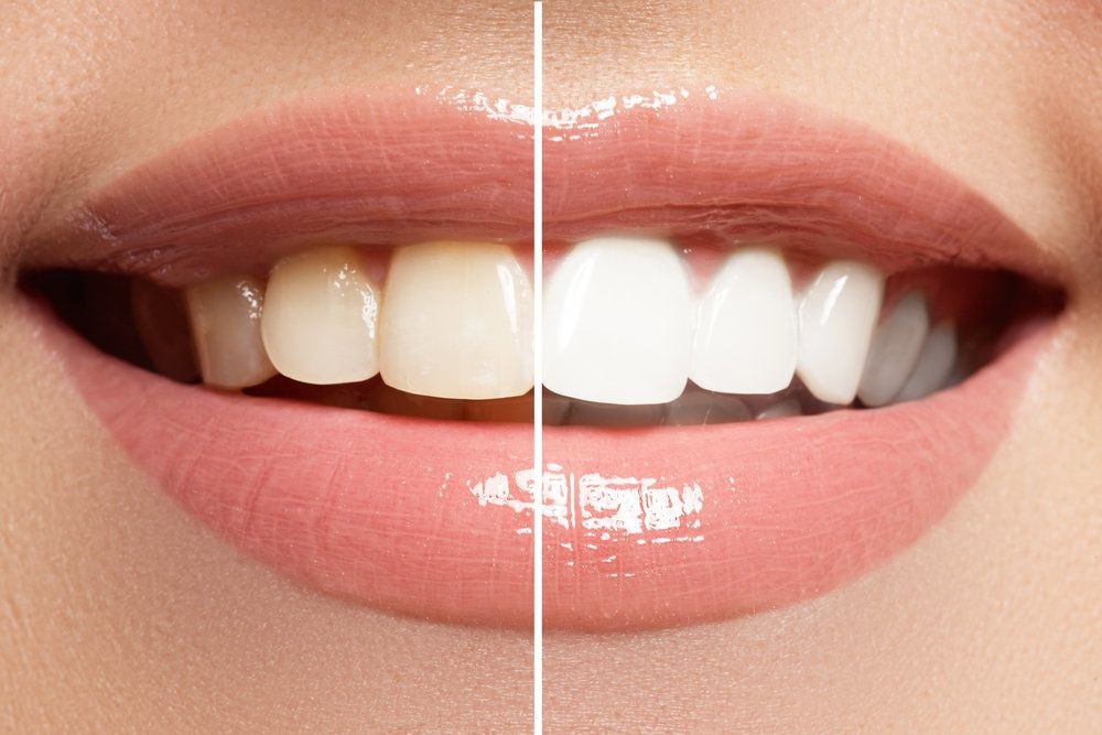 Before and after teeth whitening
