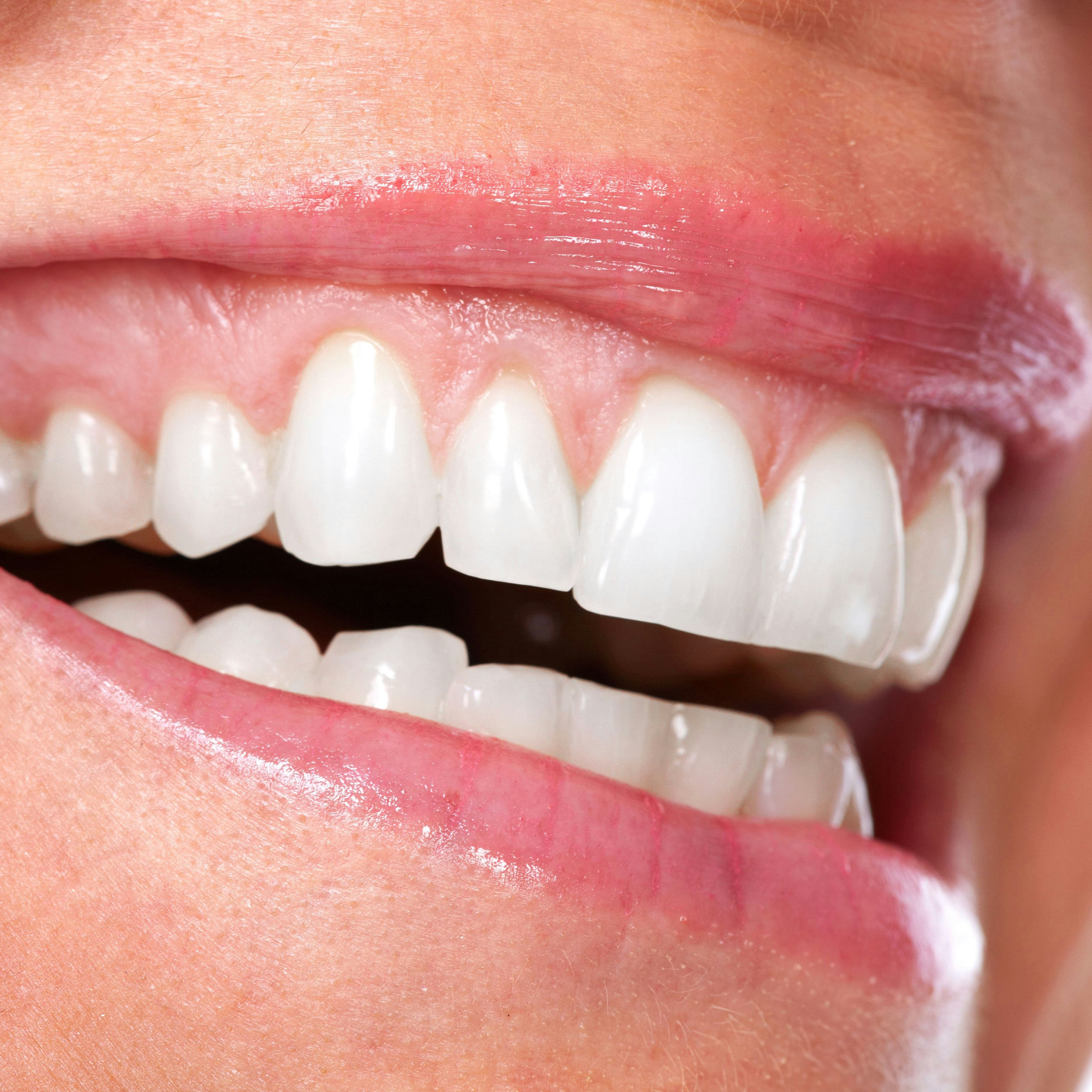 Replacement of dental veneers for receding gums - Bauer Smiles