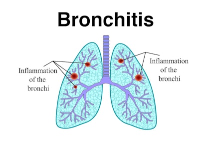 Illustration showing effects of bronchitis