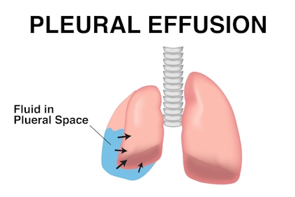 Illustration showing results of pleural effusion