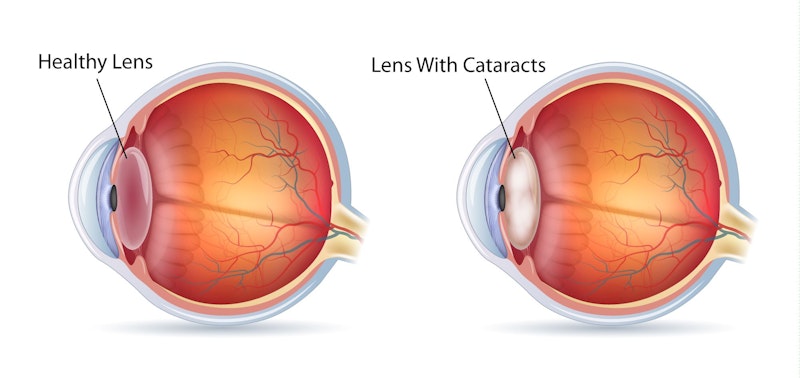Illustration of a healthy eye and an eye with cataracts