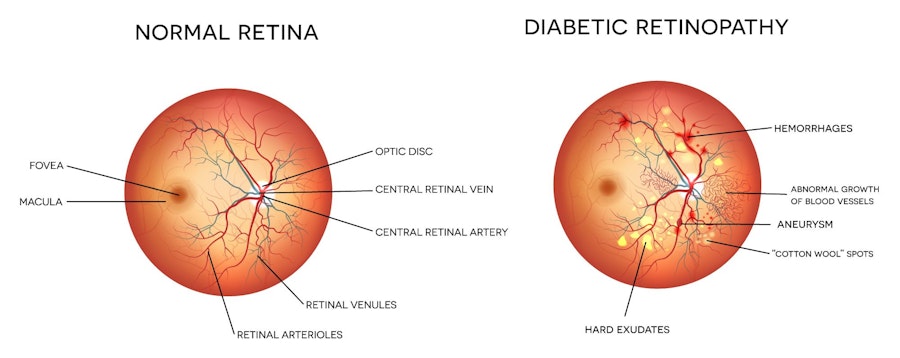 diabetic retinopathy