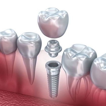 Image of dental implants