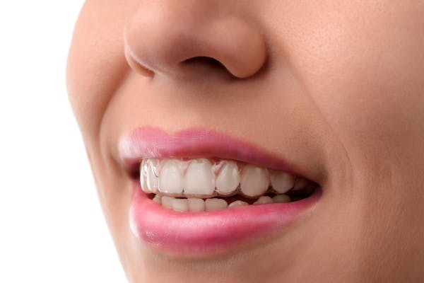 Invisalign®