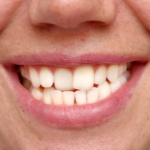 A patient with overcrowded teeth
