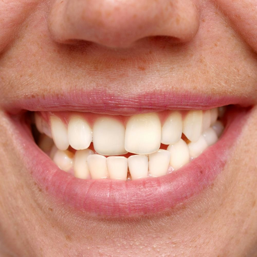 Misaligned teeth