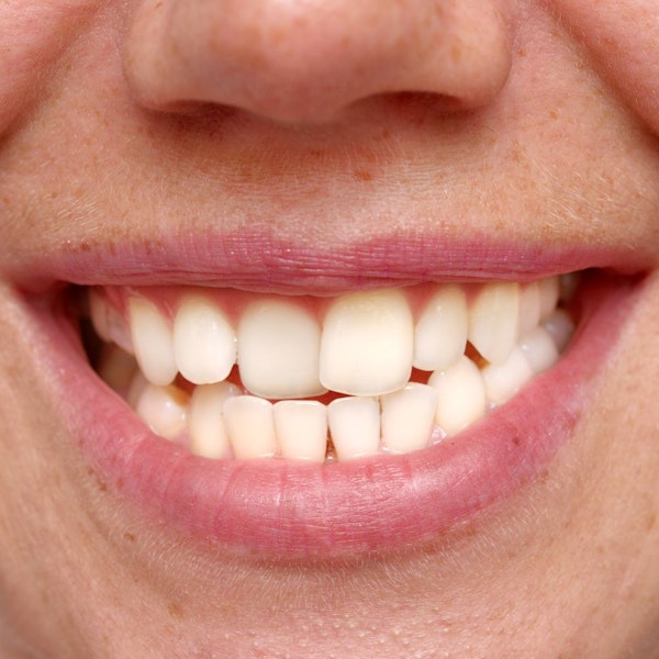 Misaligned teeth