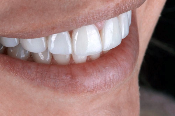 Close up of woman's teeth