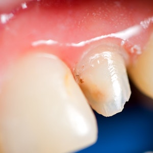Man with broken tooth