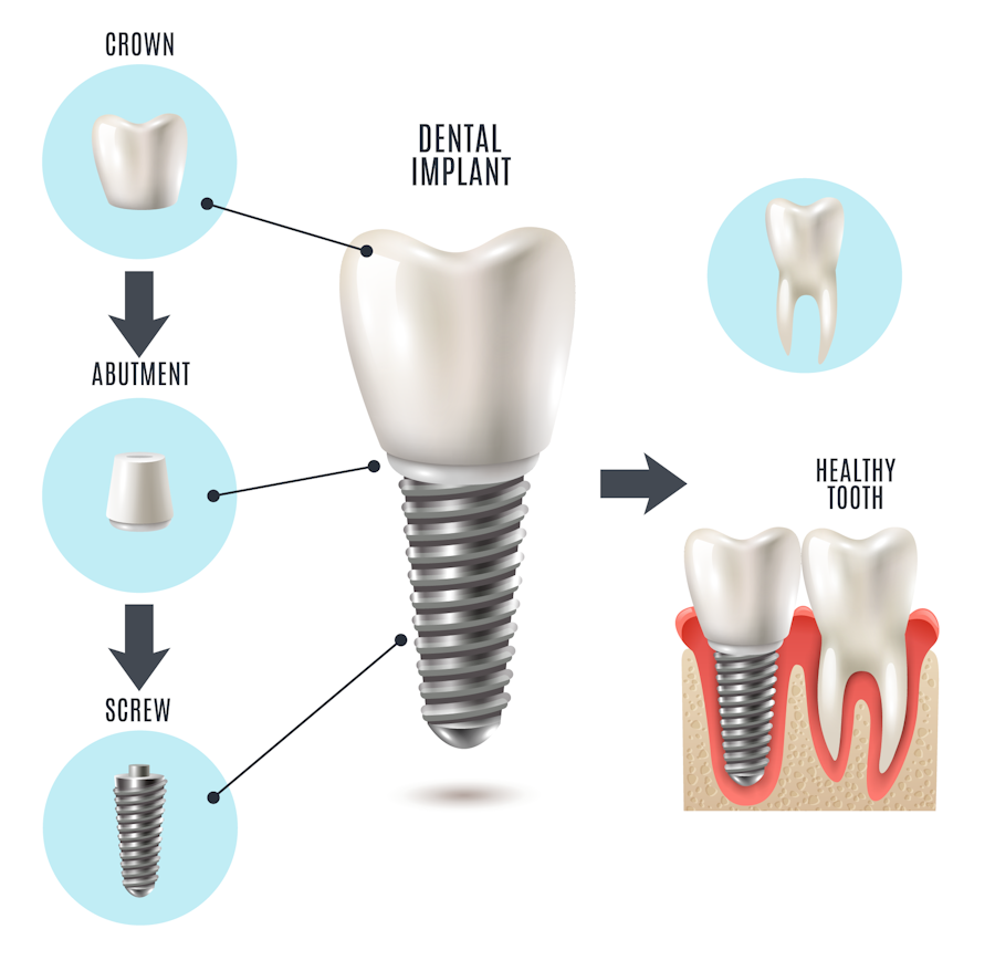 Illustration of components of an implant-supported crown