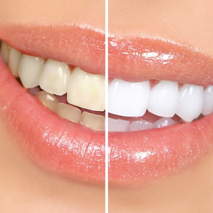 Whitening Before and After