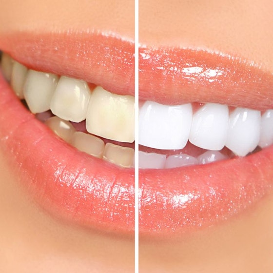 Before and after images of a teeth whitening patient