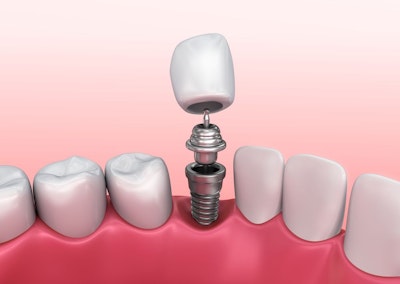 Illustration of dental implants.