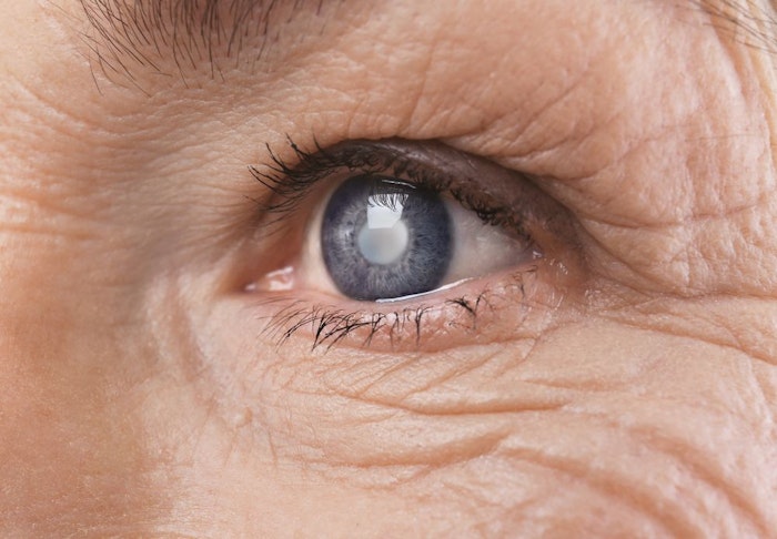 Close-up of eye with cataract 