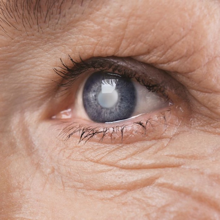 Close-up of eye with cataract