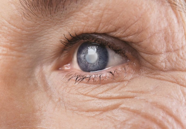 Older woman with cataracts