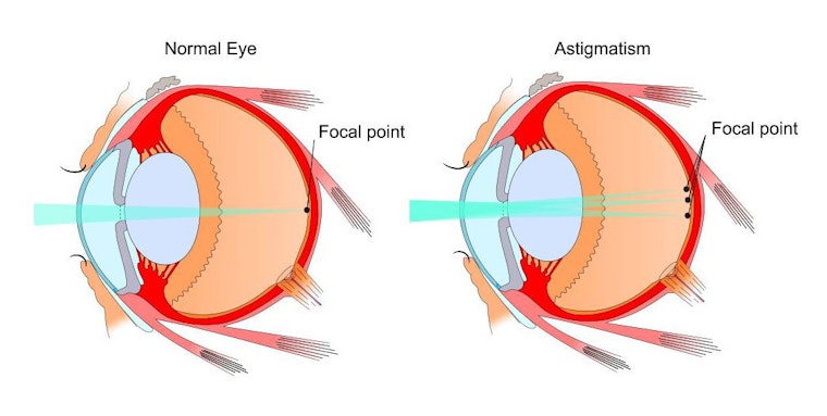 Demonstration of how light is focused in a normal eye and scattered in an eye with astigmatism.