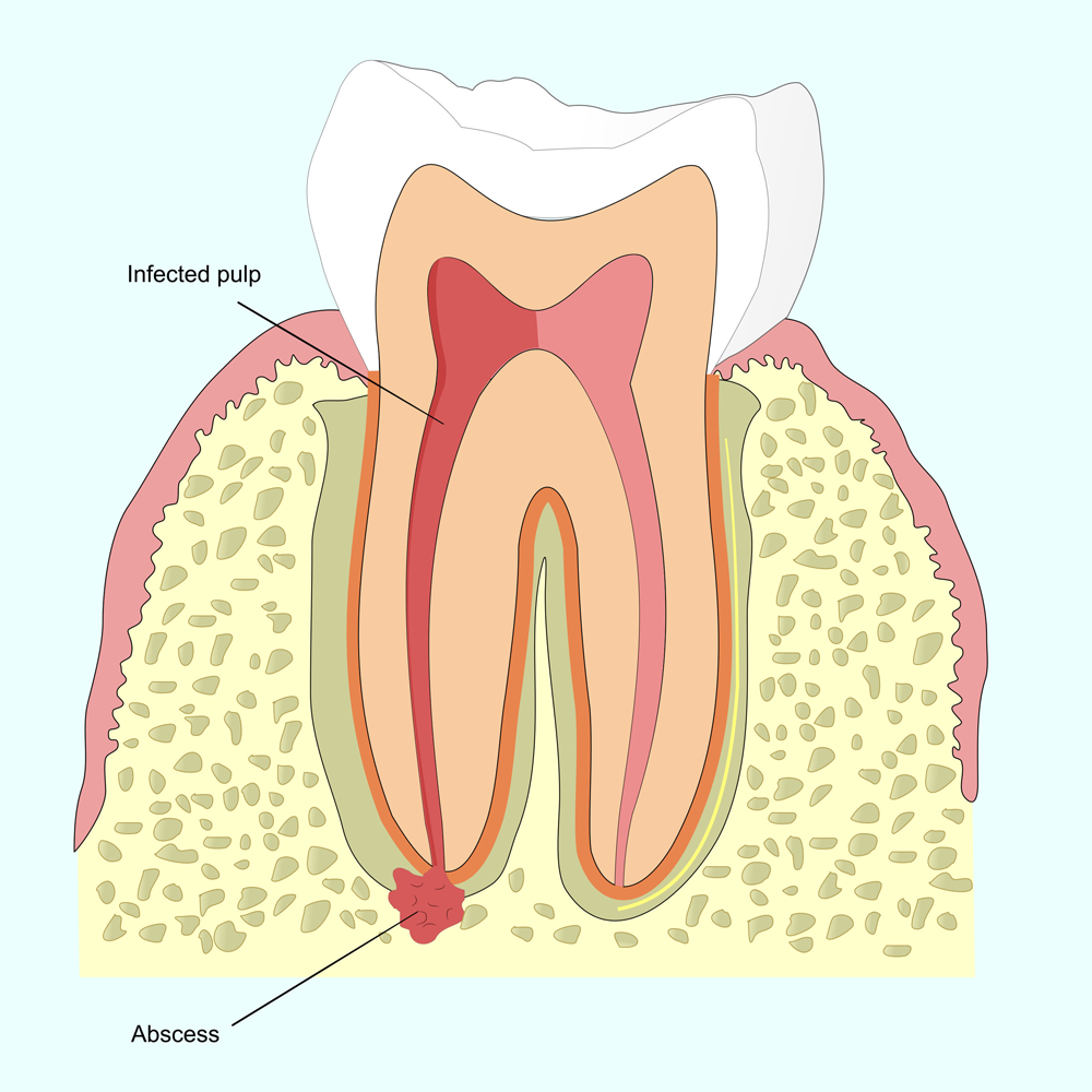 Diagram of root canal showing infected pulp and abscess