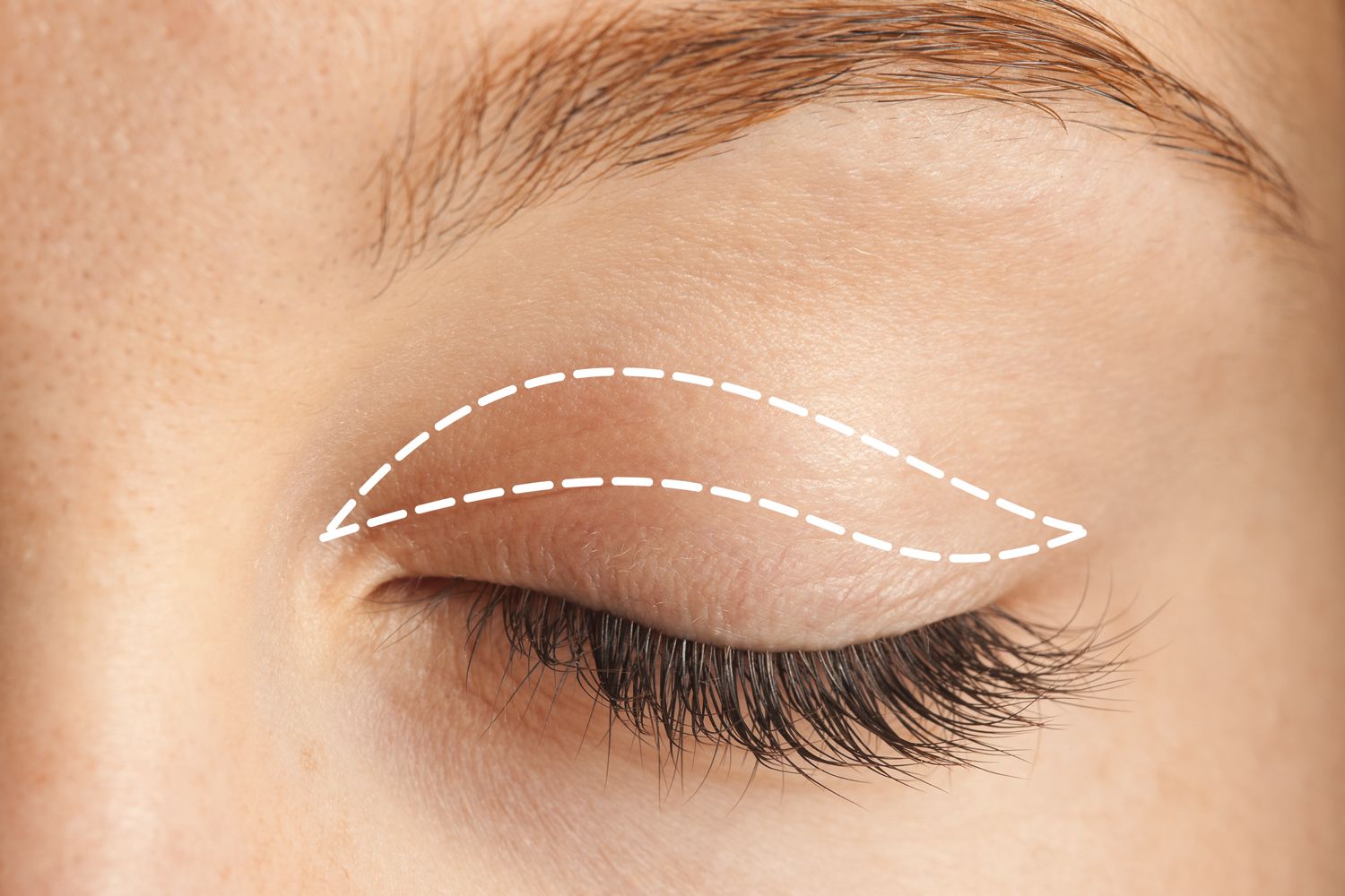 Upper Eyelid Surgery - Minneapolis, MN - Mesna Plastic Surgery