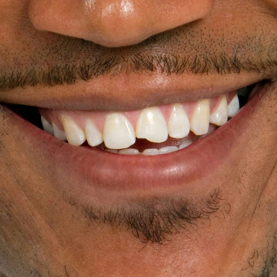 Closeup of chipped tooth