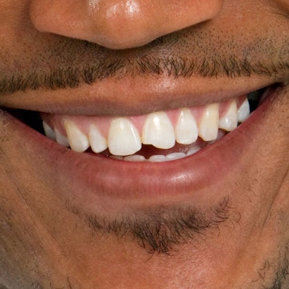 patient smiling with chipped teeth