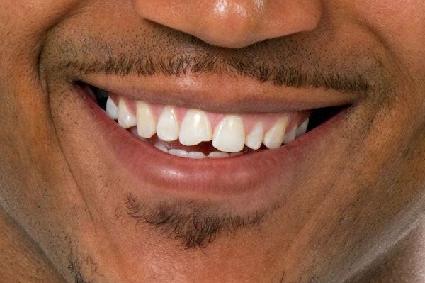 Closeup of a man's smile with dental bonding