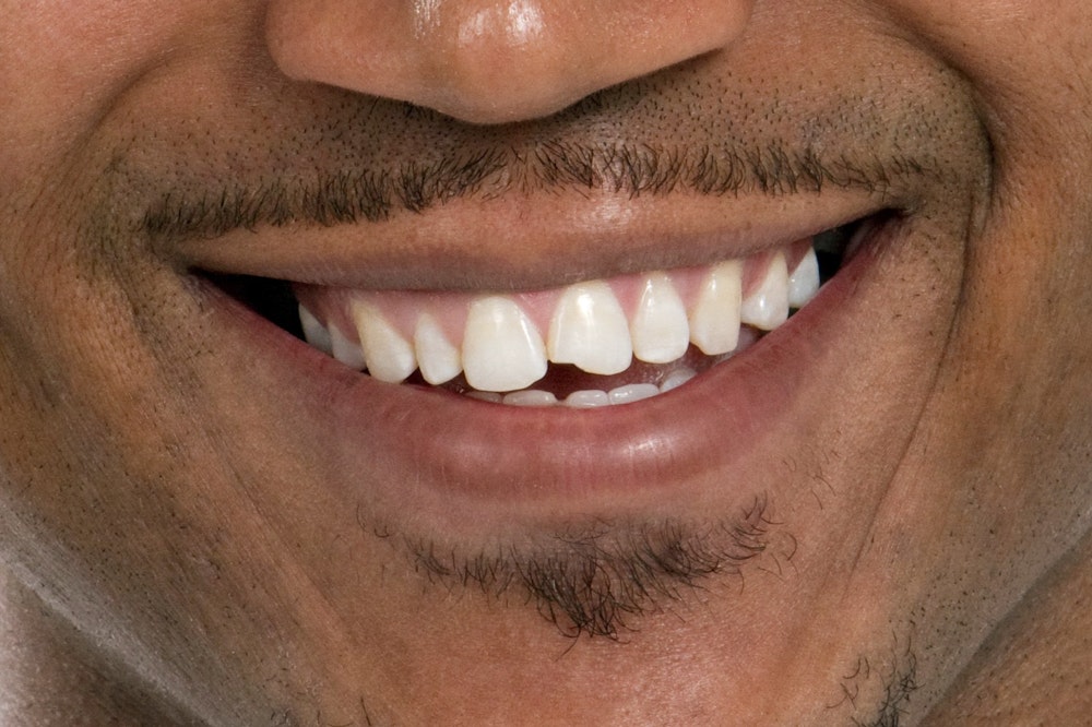 Person smiling, with teeth that are good for dental bonding