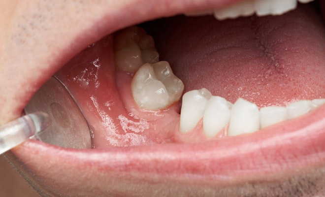 Missing Teeth
