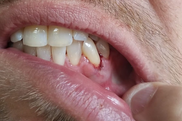 Close up of gum disease