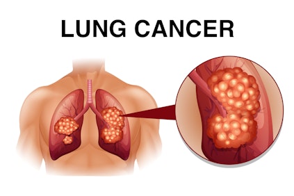Illustration highlighting the effects of lung cancer