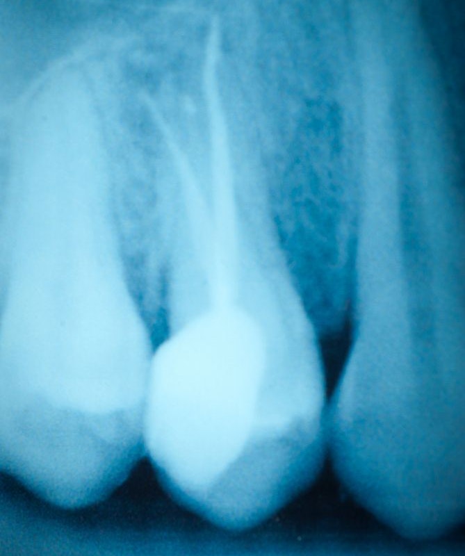 X-ray of a tooth