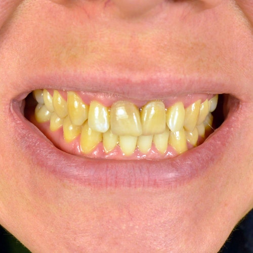 Discolored teeth