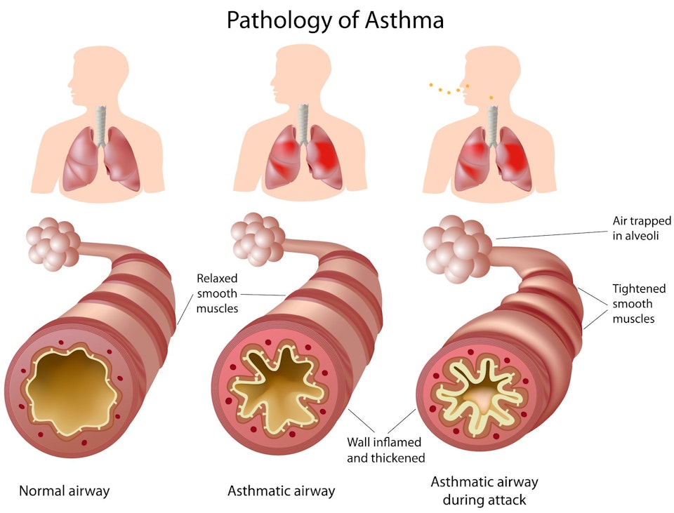 Illustration comparing a healthy airway to one with asthma