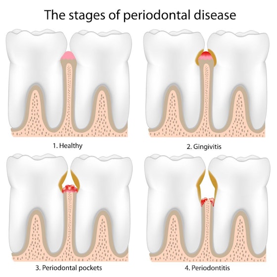 Illustration showing the stages of periodontal disease