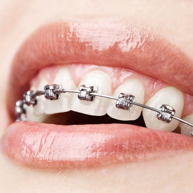 Metal Braces