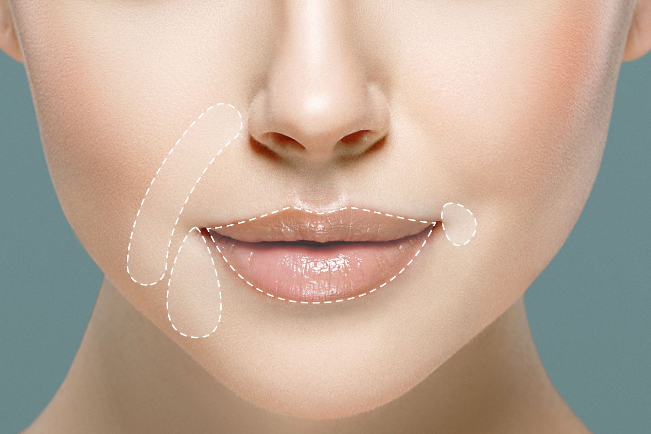 example of restylane on woman