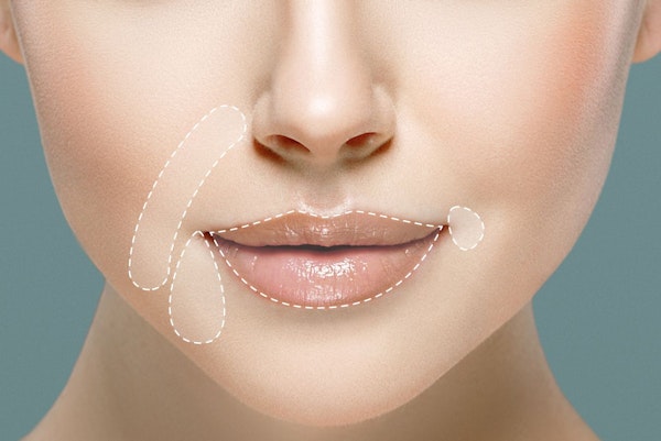 example of restylane on woman