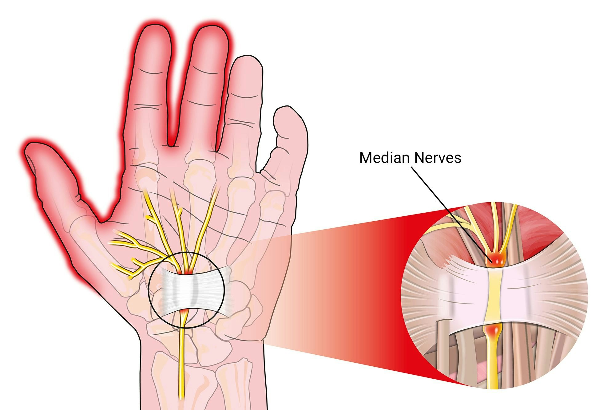 Carpal tunnel diagram